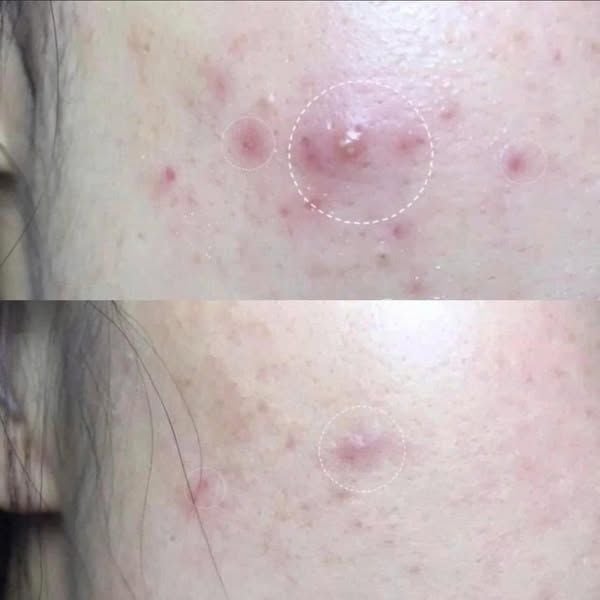 Gel Trị Mụn Glenmark Klenzit-C Gel Dành Cho Da Bị Mụn Trứng Cá, Mụn Viêm Đỏ 15gr