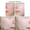 Sữa Rửa Mặt Cho Da Dầu & Da Mụn Dermacos Anti-Acne Deep Cleansing Gel 150ml