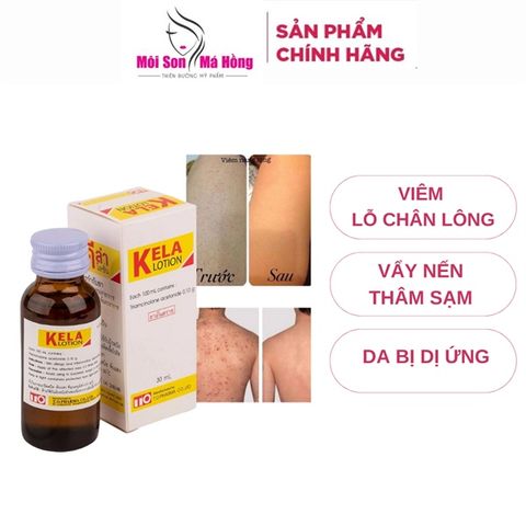 Dung dịch đặc trị viêm lỗ chân lông Kela Lotion thái lan 30ml/ 60ML