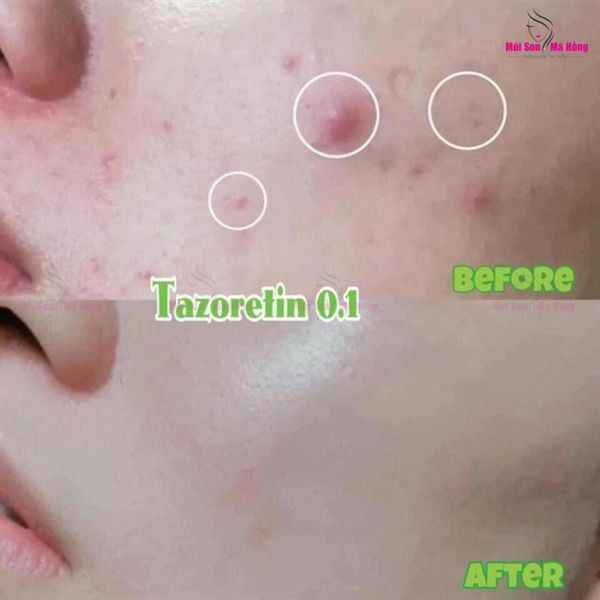 Kem Trị Mụn Tazoretin Adapalene 0.1% (Tuýp 30g)