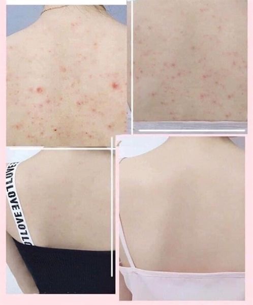 Xịt Giảm Mụn Lưng Pelican For Back Medicated Body Lotion 100ml
