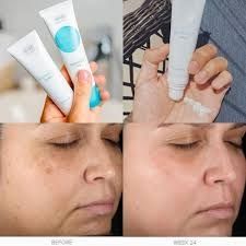 Kem Dưỡng Obagi Retinol 1.0 Ngừa Mụn Chống Lão Hóa 28g