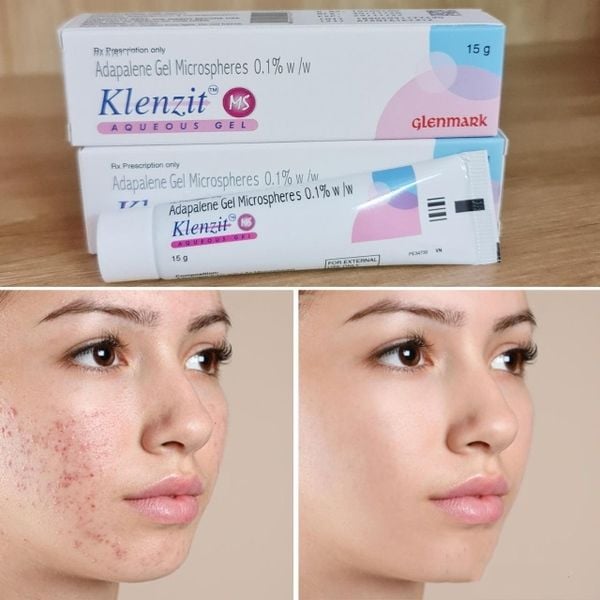 Gel Trị Mụn Klenzit MS – Mụn Ẩn, Mụn Viêm, Mụn Đầu Đen 15GR
