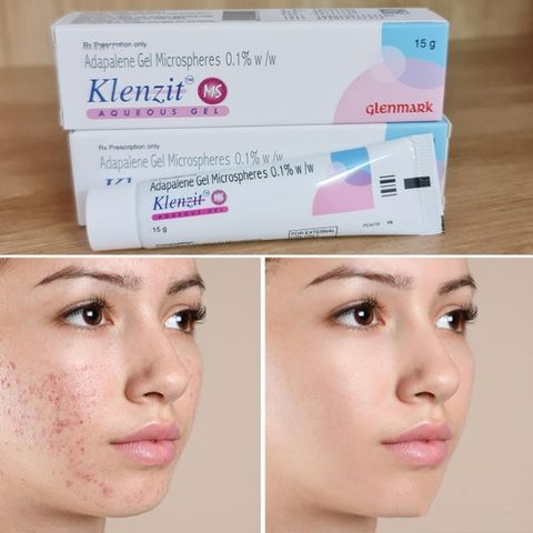 Gel Trị Mụn Klenzit MS – Mụn Ẩn, Mụn Viêm, Mụn Đầu Đen 15GR