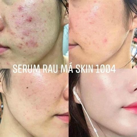Tinh Chất Skin1004 Madagascar Centella Ampoule Rau Má Giảm Mụn Phục Hồi Da 30ml/ 55ml