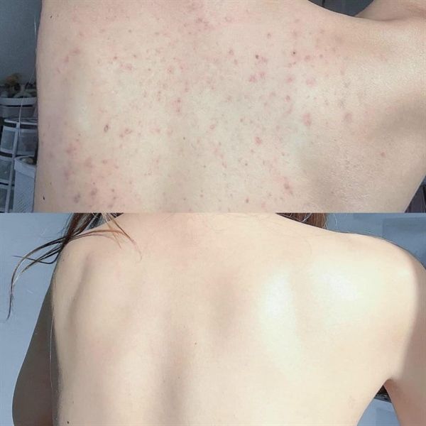 Xịt Giảm Mụn Lưng Pelican For Back Medicated Body Lotion 100ml
