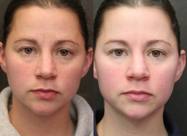 Kem Dưỡng Obagi Retinol 1.0 Ngừa Mụn Chống Lão Hóa 28g