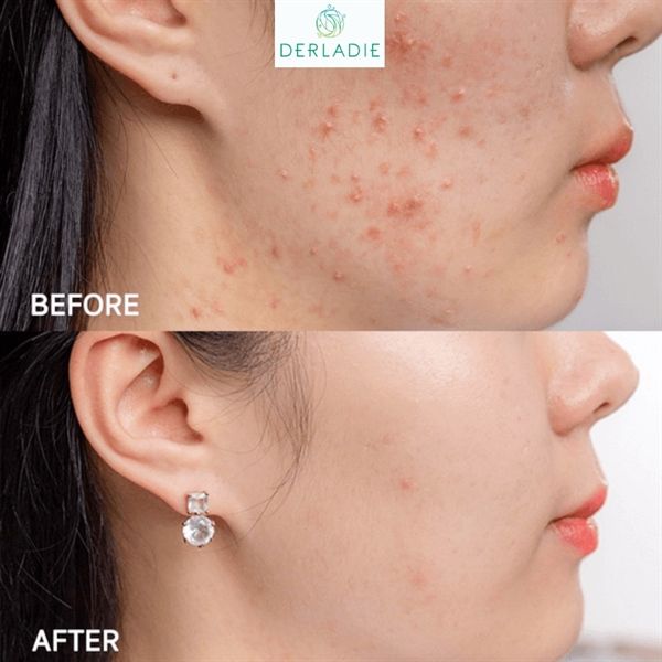 SERUM Derladie TrTinh Chất Derladie Tràm Trà Làm Giảm Mụn 30ml Herbal Ampoule For Blemishàm Trà Làm Giảm Mụn 30ml