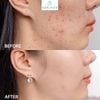 SERUM Derladie TrTinh Chất Derladie Tràm Trà Làm Giảm Mụn 30ml Herbal Ampoule For Blemishàm Trà Làm Giảm Mụn 30ml