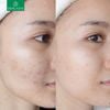 SERUM Derladie TrTinh Chất Derladie Tràm Trà Làm Giảm Mụn 30ml Herbal Ampoule For Blemishàm Trà Làm Giảm Mụn 30ml