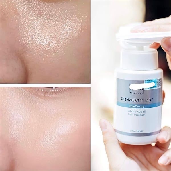 Nước Hoa Hồng OBAGI Clenziderm MD Pore Therapy Giảm Mụn 148ml