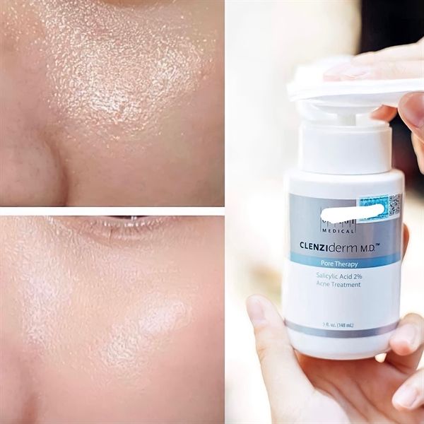 Nước Hoa Hồng OBAGI Clenziderm MD Pore Therapy Giảm Mụn 148ml