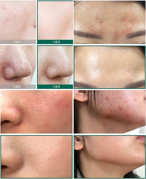 Serum Some By Mi AHA-BHA-PHA Cho Da Mụn 50ml AHA-BHA-PHA 30 Days Miracle Serum 50ml