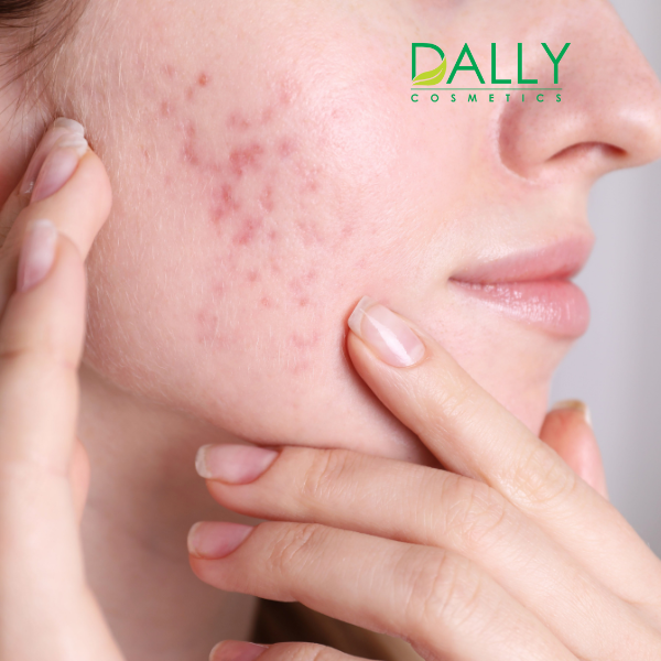  Chăm sóc da mụn nhẹ 