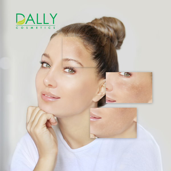  Chăm sóc da nám nhẹ, da không đều màu 