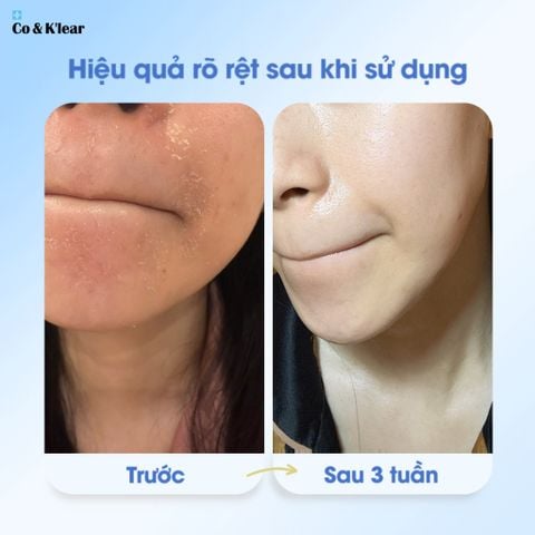  Co&K'lear Serum B5+HA Phục Hồi & Cấp Ẩm Sâu 