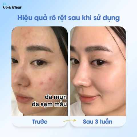  Co&K'lear Niacinamide Ampoule 20% Tinh Chất Hoa Hồng Damask Dưỡng Sáng & Se Khít Lỗ Chân Lông 
