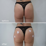  GOLDFILL® VOLUME - Mông/Hông/Tay/Bikini 