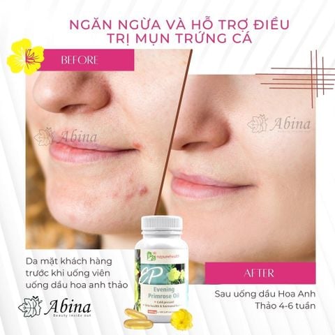 Viên Tinh Dầu Hoa Anh Thảo Ép Lạnh Cân Bằng Nội Tiết Nữ NZPureHealth EPO 100 Viên