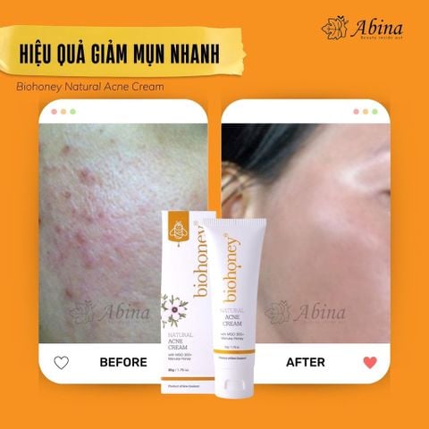 Kem Mụn Giảm Thâm Mật Ong Manuka MG300+ BioHoney Natural Acne Cream 50g